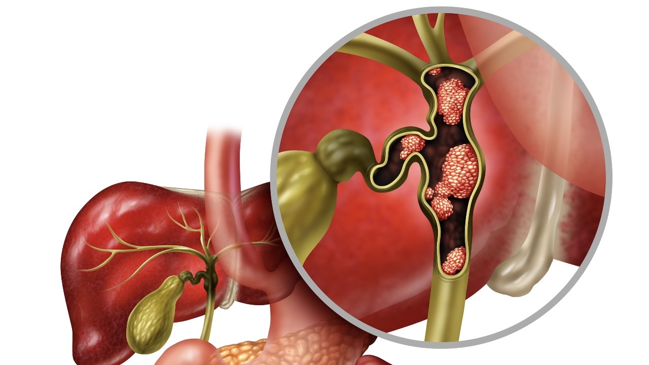 Erman Akkus: ctDNA in resected biliary tract cancers