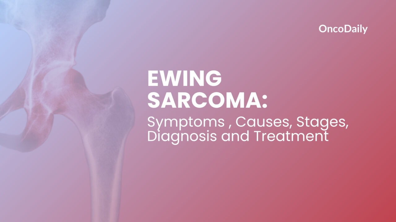 Ewing Sarcoma: Symptoms , Causes, Stages, Diagnosis and Treatment