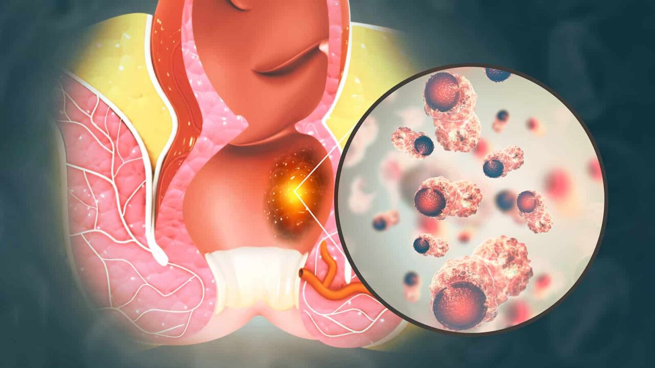 Senthil Kumar: Comprehensive Overview of First-Line Treatment for Metastatic Anal Cancer