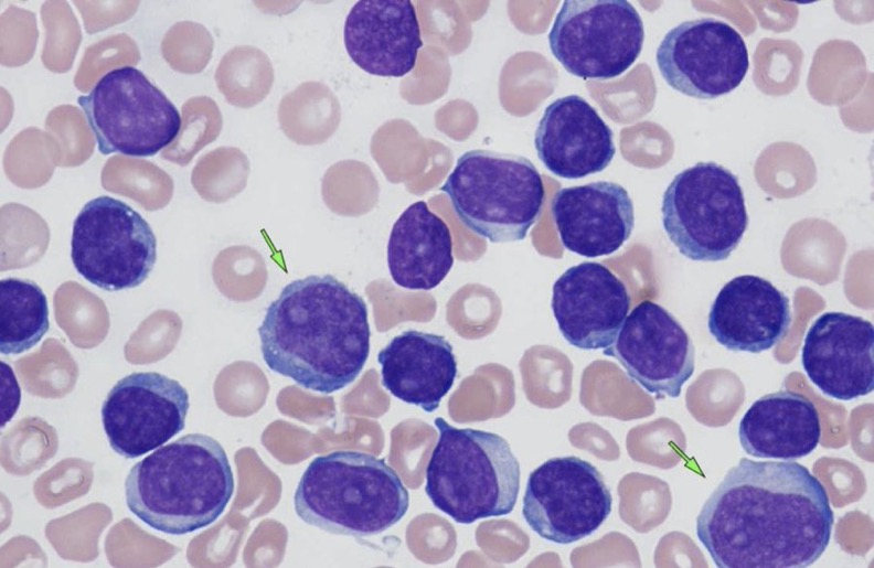 Aaron Goodman: Mature B-cell Leukemias