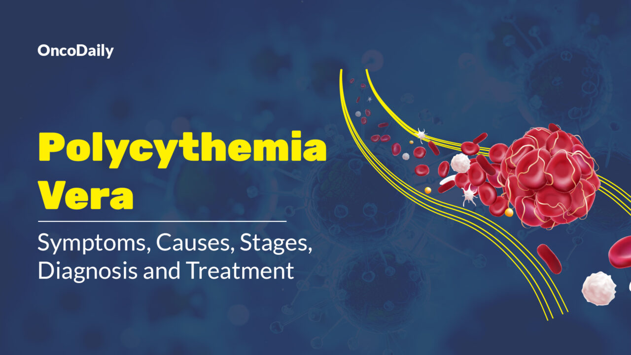 Polycythemia Vera : Symptoms, Causes, Stages, Diagnosis and Treatment