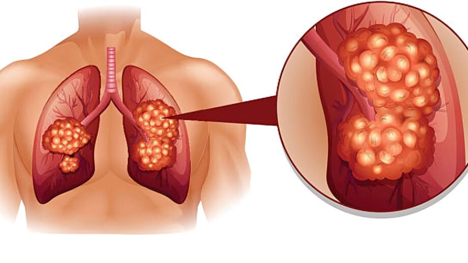 Detecting lung cancer earlier: your questions answered – Lung Cancer Europe