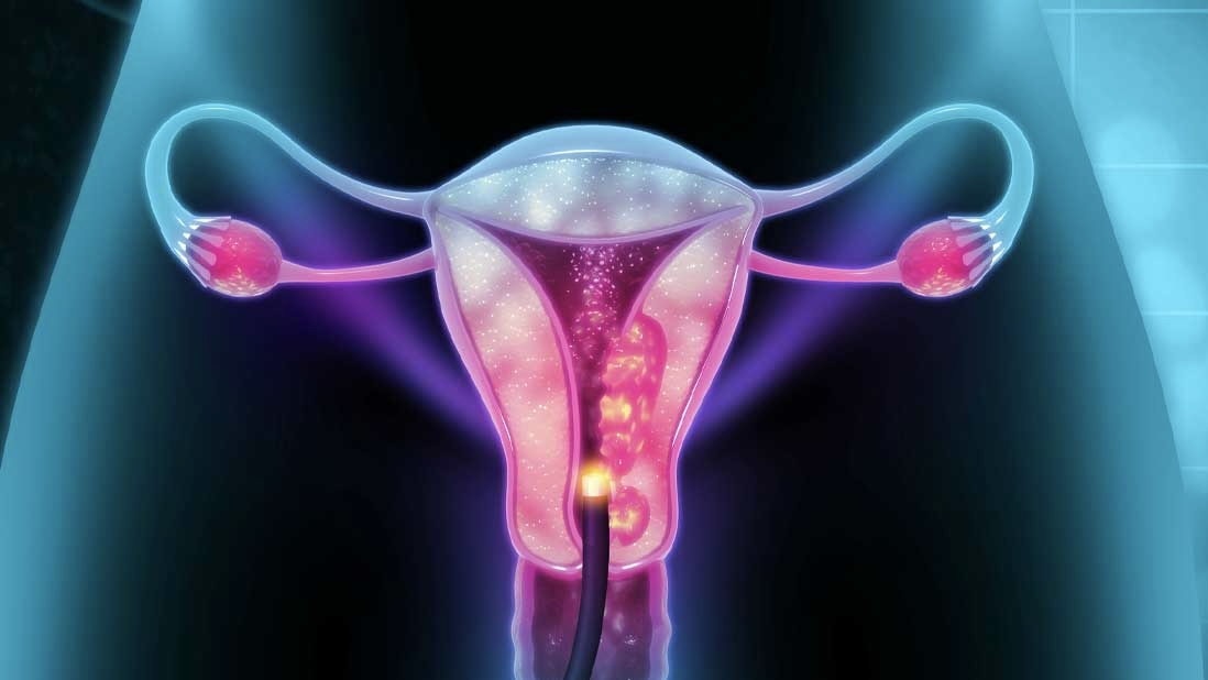 Shahrin Ahmed: The key solutions for increasing life-saving cervical cancer screenings