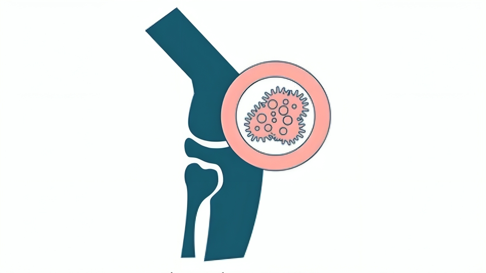 Senthil Kumar: Systemic Treatment for Advanced/Metastatic Synovial Sarcoma