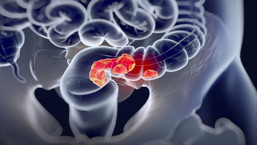 Krishan Jethwa: Pooled CAO/ARO/AIO-12 and OPRA Rectal trials