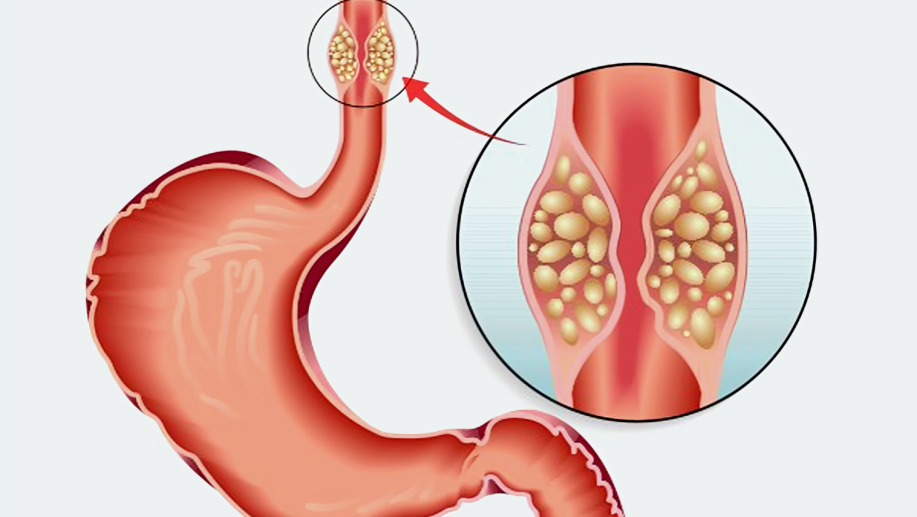 Endoscopically injected oncolytic virus OBP-301 in medically inoperable esophageal cancer