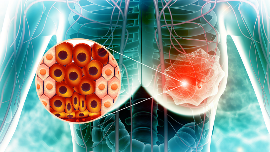 Final analysis of the PRECIOUS phase 3 trial