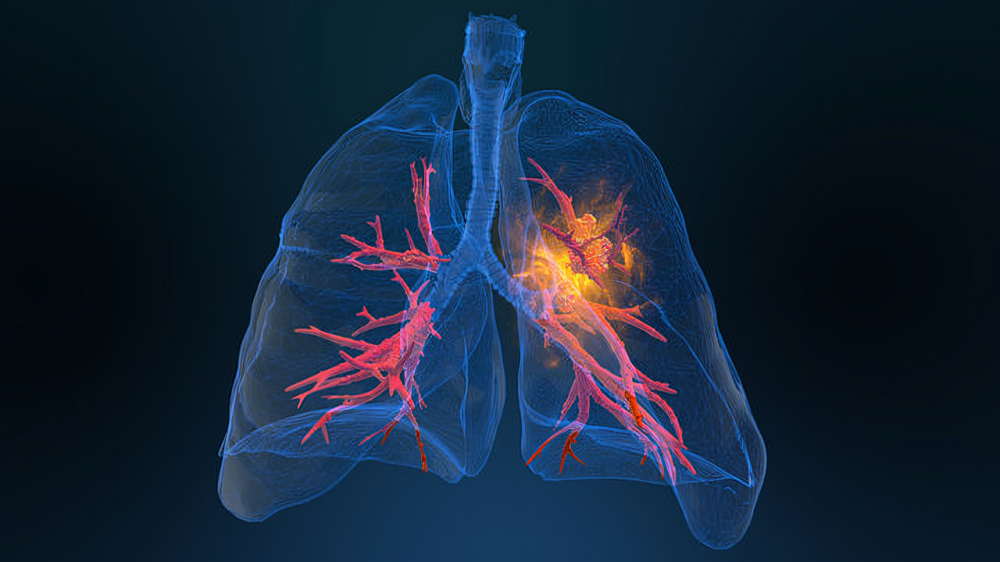 NSCLC treated with EGFR inhibitors – EGFR Resisters