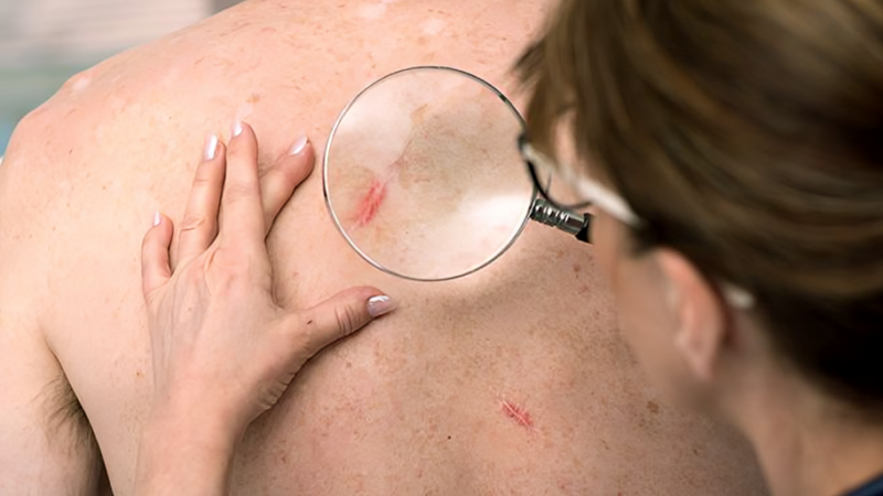 Akhil Santhosh: Prevention of dermatologically adverse events with amivantamab combinations