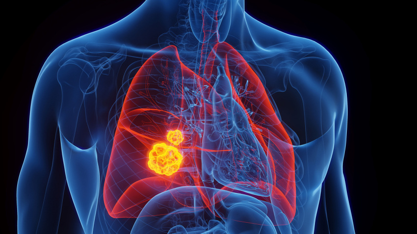 Simon Heeke: Analysing ctDNA and ctRNA to improve detection of ALK rearrangements in NSCLC