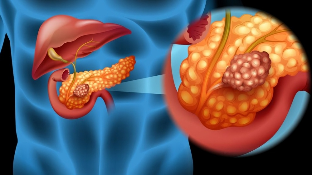 Pancreatic cancer remains the 3rd leading cause of cancer death in the US – CA: A Cancer Journal for Clinicians