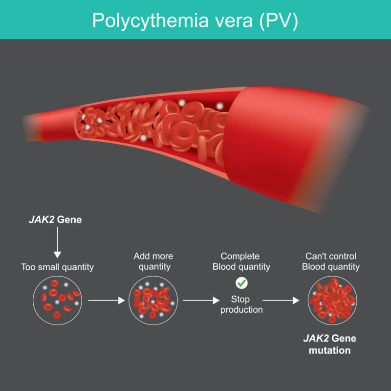 mutation in the JAK2 (Janus kinase 2) gene