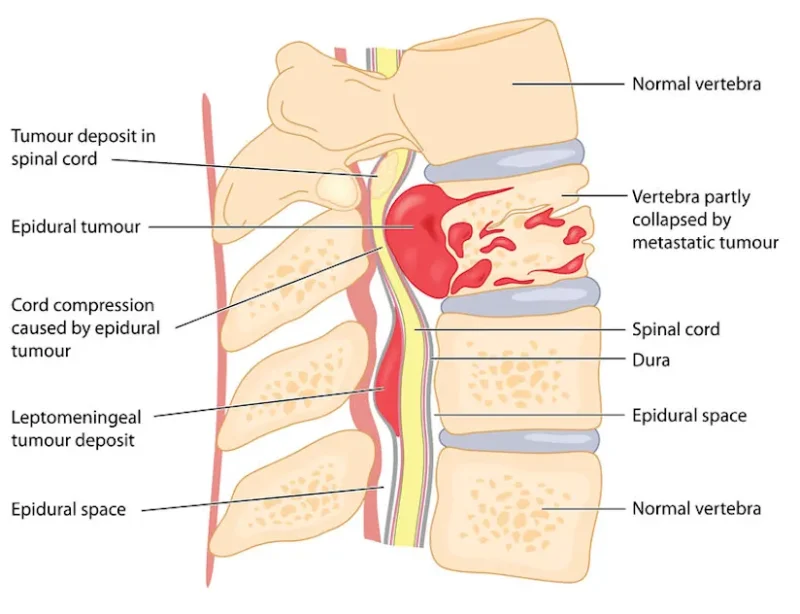 Spinal tumors