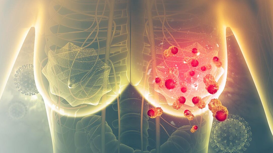 Yakup Ergün: Metronomic Capecitabine Plus AI as Initial Therapy in HR+/HER2- mBC by Ruo-Xi Hong et al.