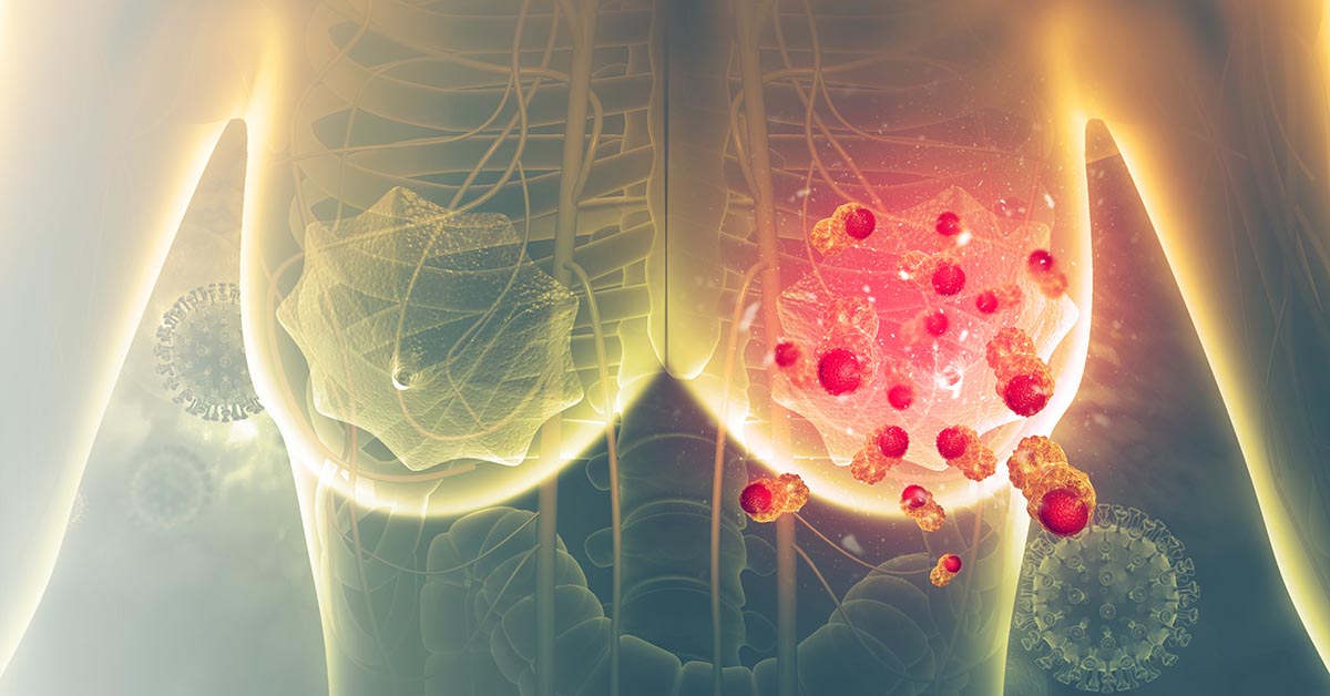 Yakup Ergün: Metronomic Capecitabine Plus AI as Initial Therapy in HR+/HER2- mBC by Ruo-Xi Hong et al.