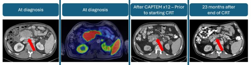 Thor Halfdanarson: Radiosensitivity of NET in Locally Advanced G2 Pancreatic Tumor Treated with CAPTEM and CRT