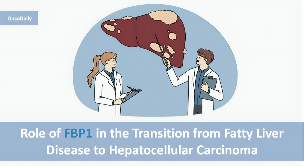 Exploring the Role of FBP1 in the Transition from Fatty Liver Disease to Hepatocellular Carcinoma