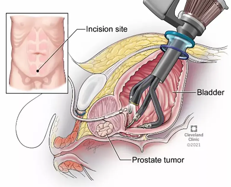 Robotic Prostatecomy