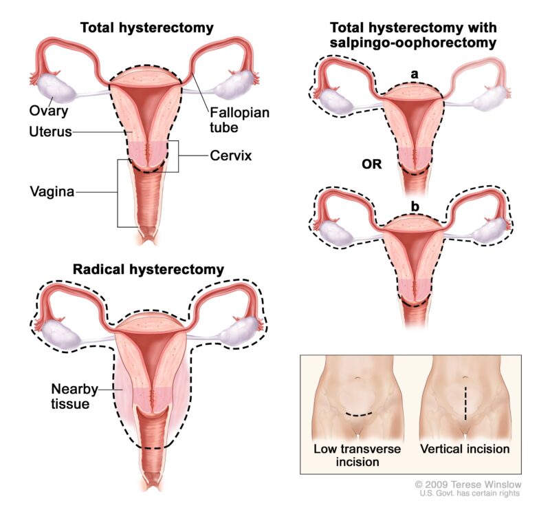 Hysterectomy