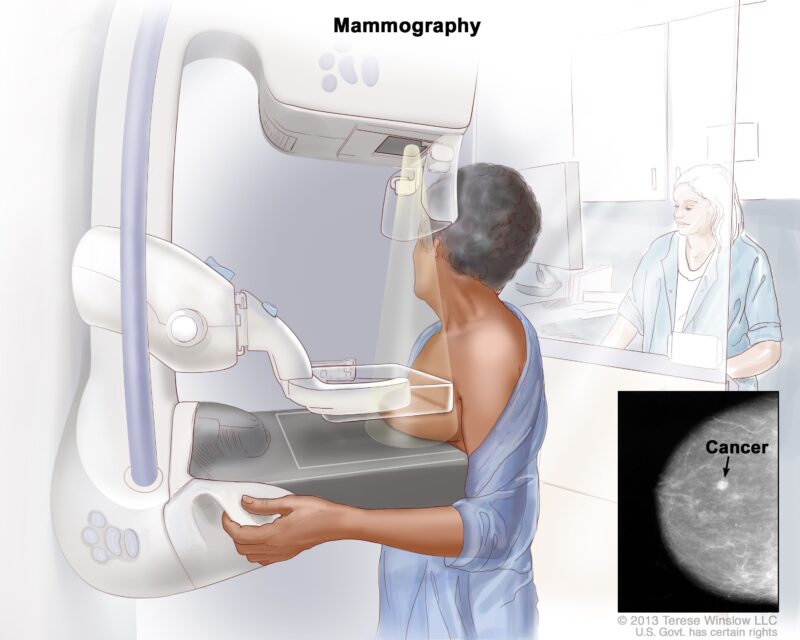 Mammography