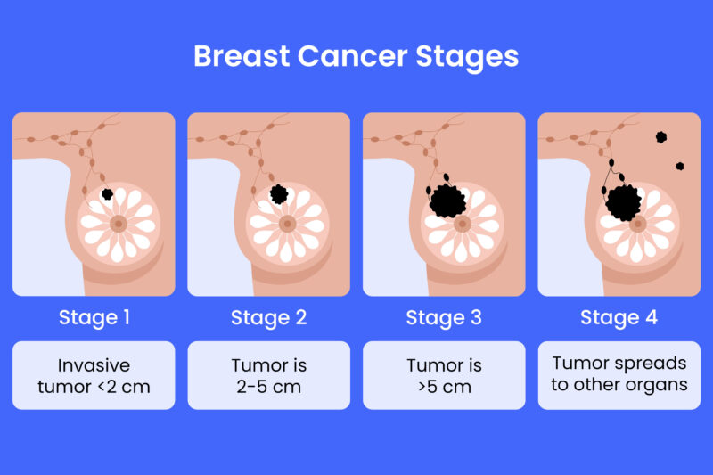 Breast Cancer Stages