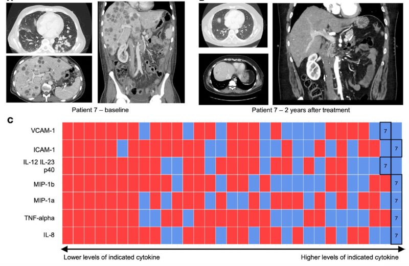 Tian Zhang: Our latest paper on circulating immune biomarkers for metastatic kidney cancer