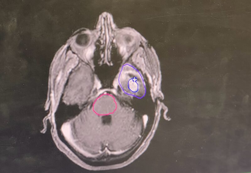 Our first hypofractionated glioblastoma multiforme treatment - UTSW Radiation Oncology