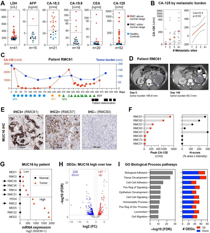 Pavlos Msaouel: Serum CA-125 as a biomarker for Renal Medullary Carcinoma