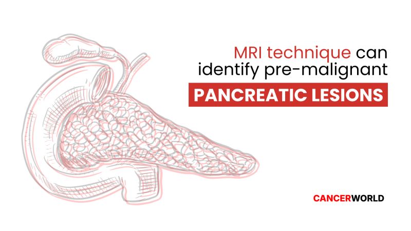 A breakthrough in Pancreatic Cancer detection – CancerWorld