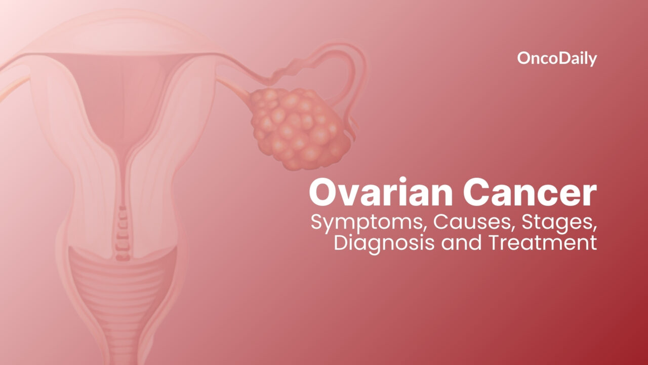 Ovarian Cancer: Symptoms, Causes, Stages, Diagnosis and Treatment