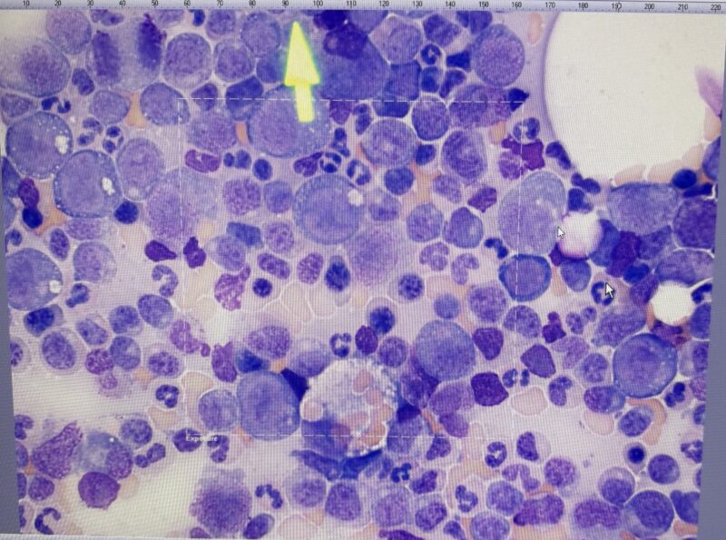 Talha Badar: Interesting case of AMML with hemophagocytosis