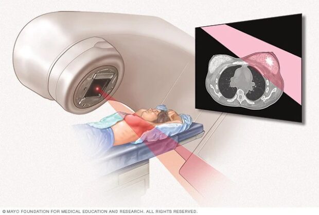 radiotherapy for breast