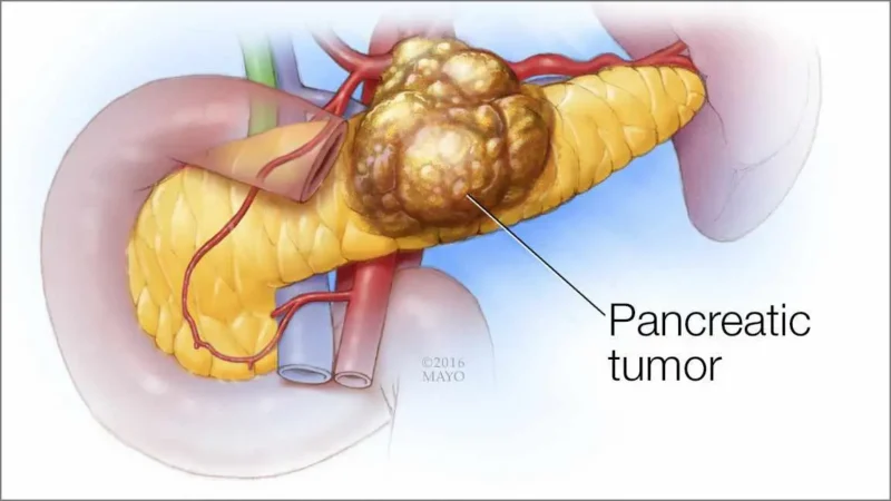 Pancreatic cancer