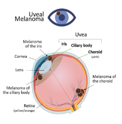 uveal melanoma treatment