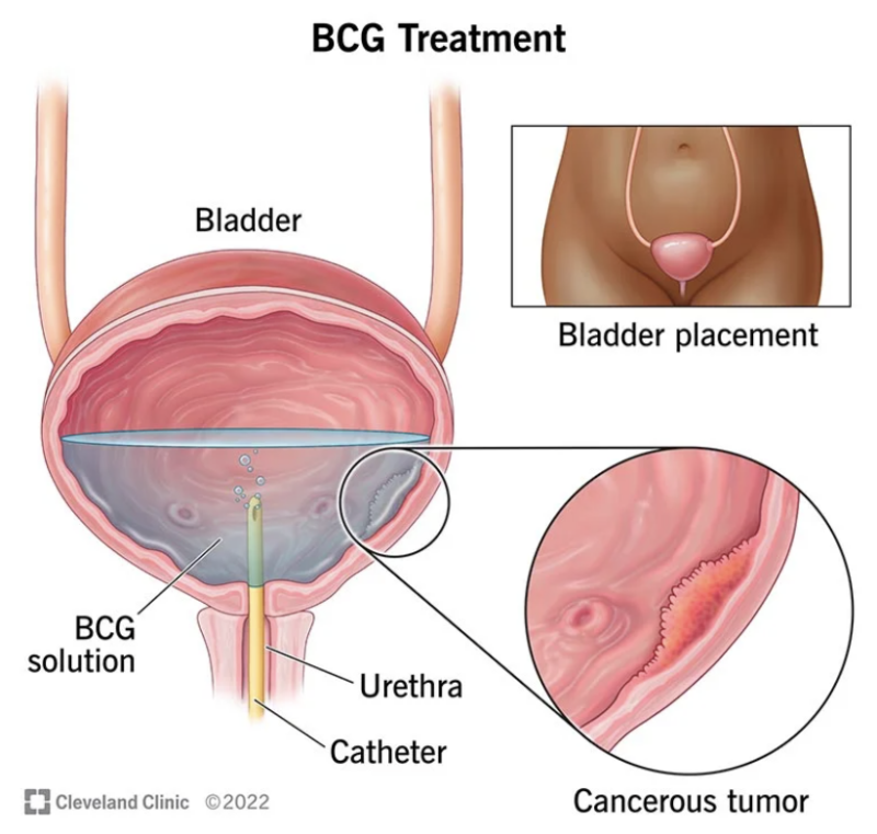 FDA Authorizes ImmunityBio to Provide Recombinant BCG as Alternative to TICE BCG Shortage for Bladder Cancer