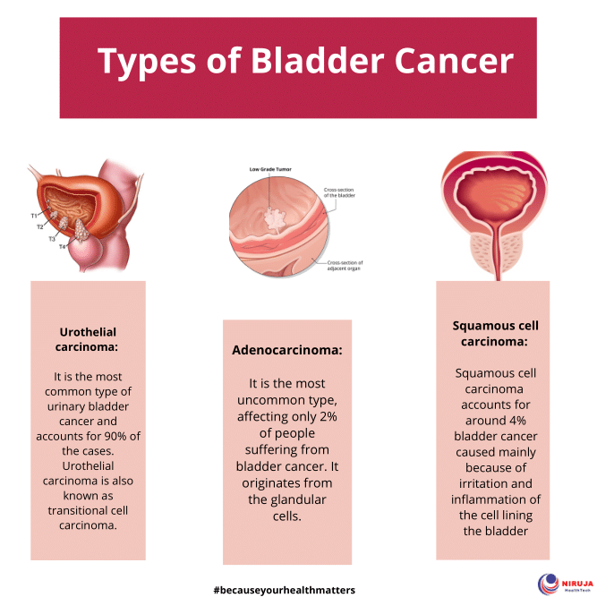 Types of Bladder Cancer