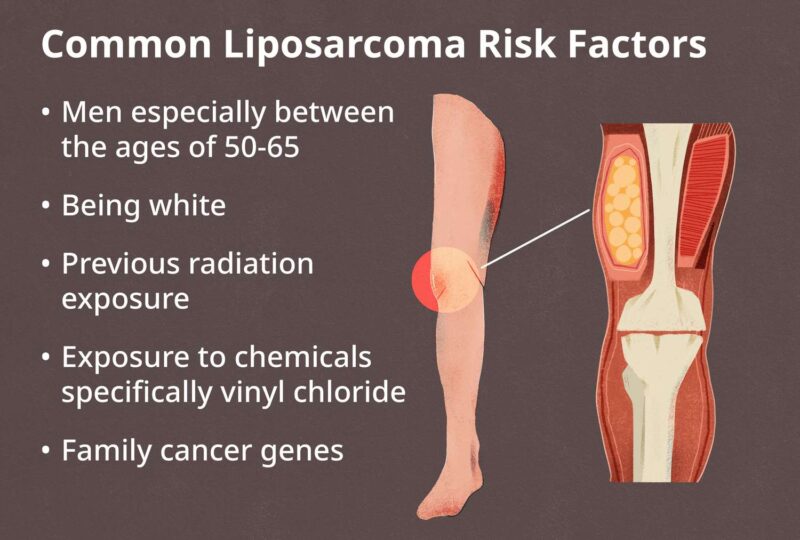 Risk Factors of Liposarcoma