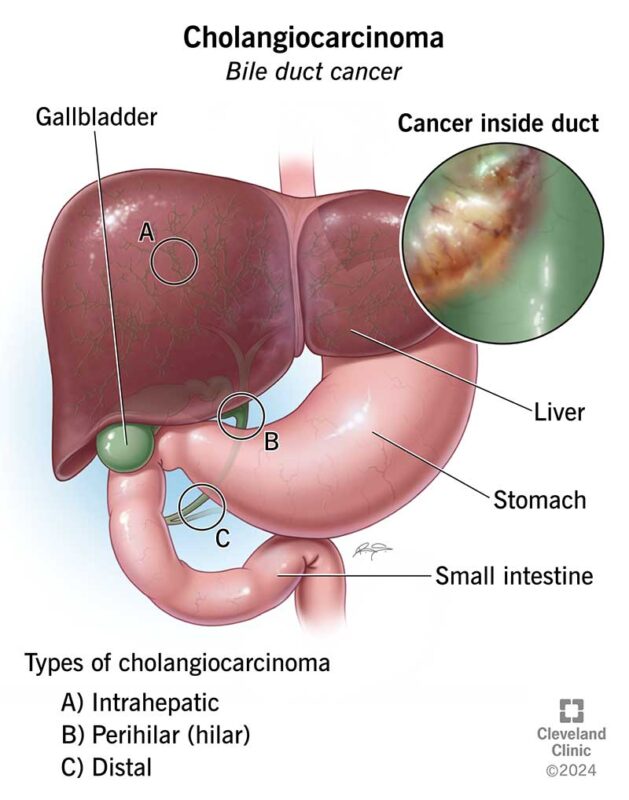 Types of cholangiocarcinoma