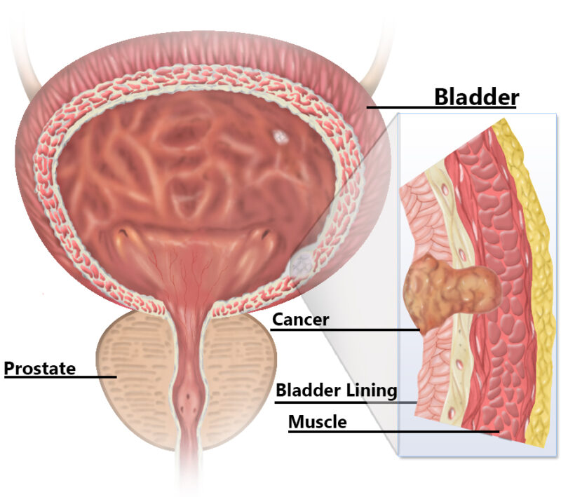 Bladder cancer 