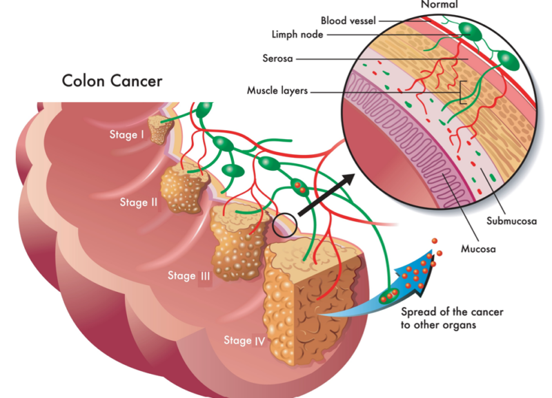 colorectal-cancer-stages