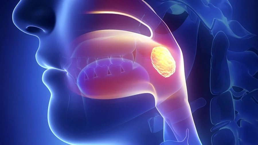 Reduced-volume vs conventional-volume radiotherapy after induction chemotherapy in nasopharyngeal carcinoma