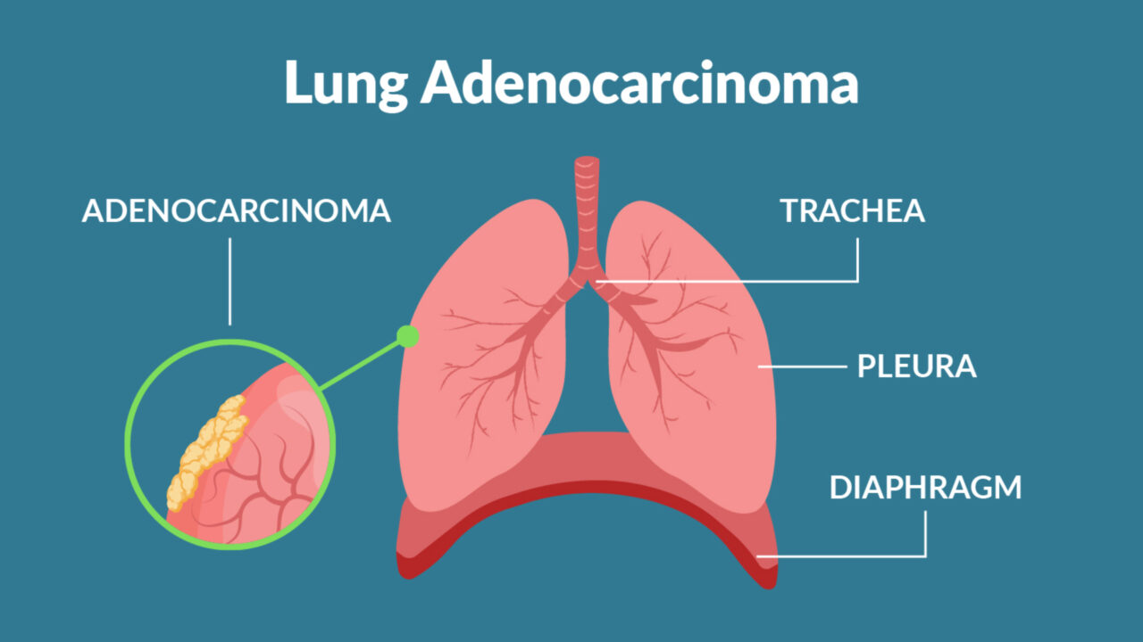 Jarushka Naidoo: Mucinous lung adenocarcinomas – clinical features and outcomes