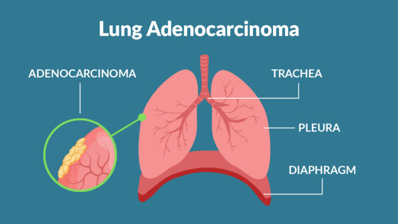 Jarushka Naidoo: Mucinous lung adenocarcinomas – clinical features and outcomes