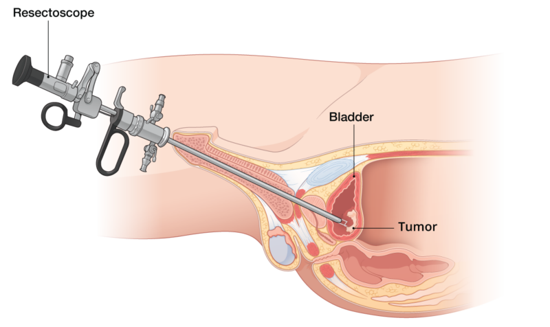 transurethral resection of the bladder tumor