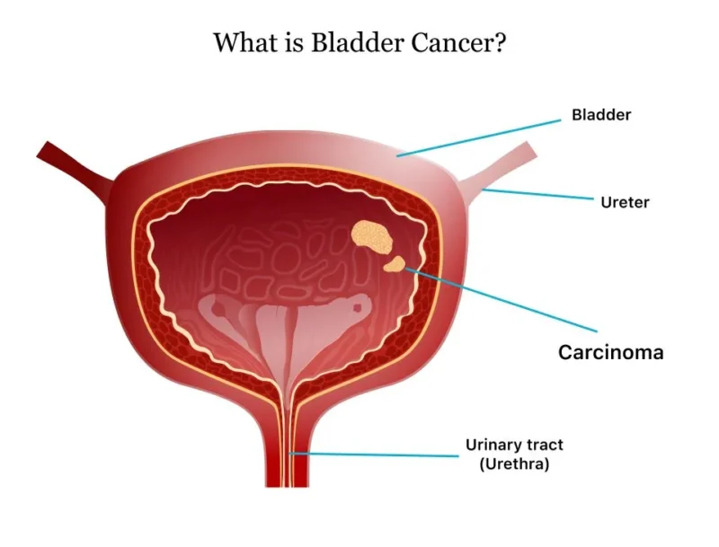 Bladder cancer