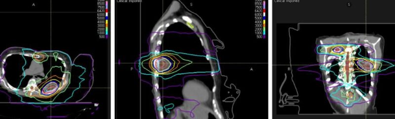 Joe Y Chang: Can lung cancer patients live with metastatic disease?