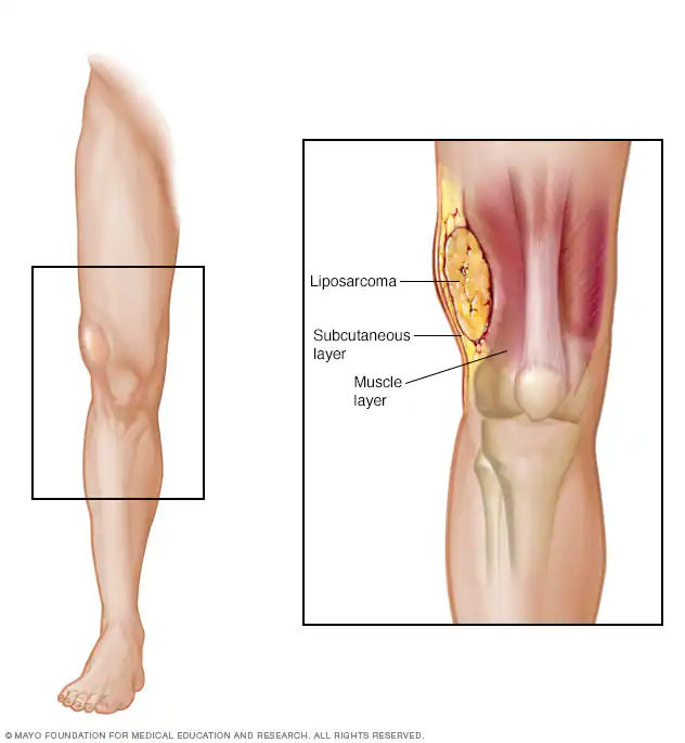 liposarcoma