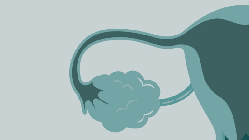 Clinician insights on the opportunities and challenges in ovarian cancer in LMIC – World Ovarian Cancer Coalition