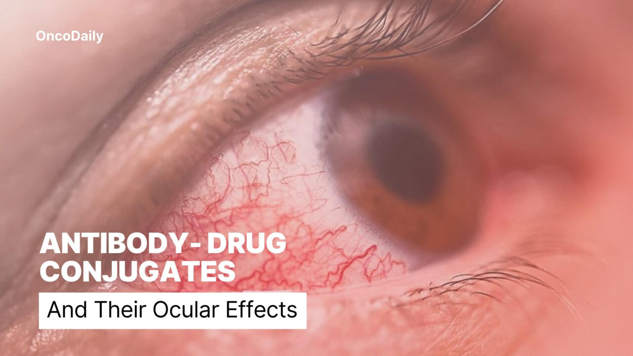 Antibody-Drug Conjugates and Their Ocular Effects in Cancer Treatment: Efficacy and Toxicity