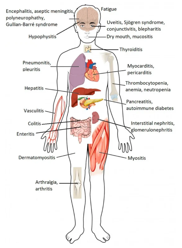 Side Effects of Cancer Immunotherapy